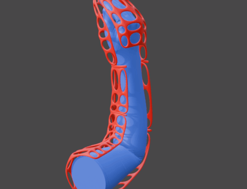 3D-Printed CIMT Constraint Orthosis